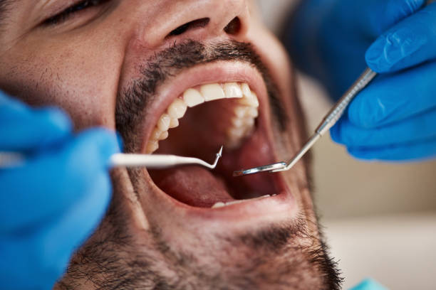 Best Knocked-Out Tooth (Avulsed Tooth) Treatment in Blackwood, NJ